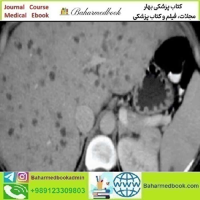 ARRS State of the Art Liver Imaging in Cirrhosis 2021 vide