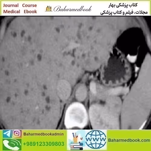 ARRS State of the Art Liver Imaging in Cirrhosis 2021 vide