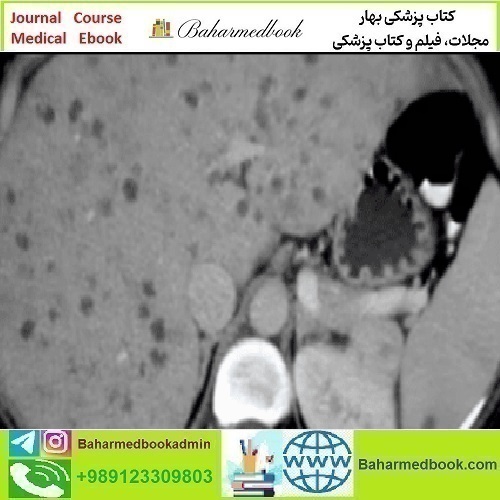 ARRS State of the Art Liver Imaging in Cirrhosis 2021 vide