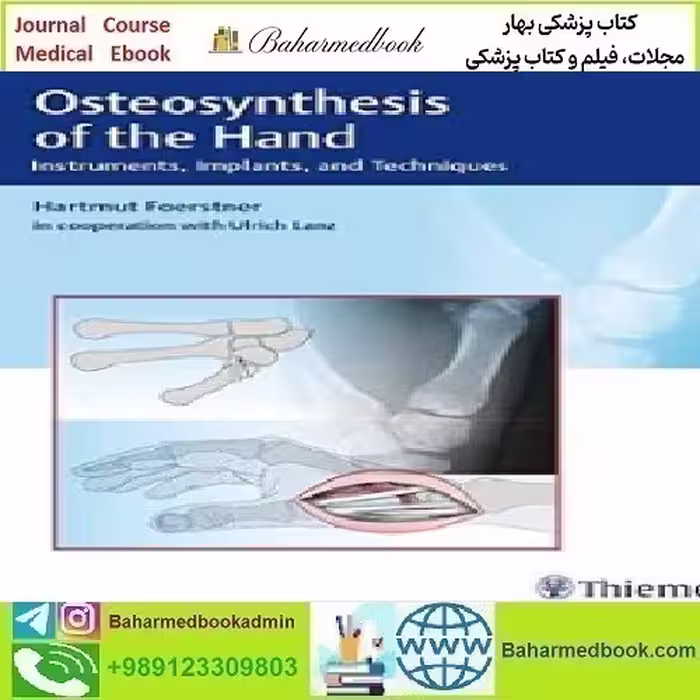 Osteosynthesis of the Hand Instruments Implants and Technique