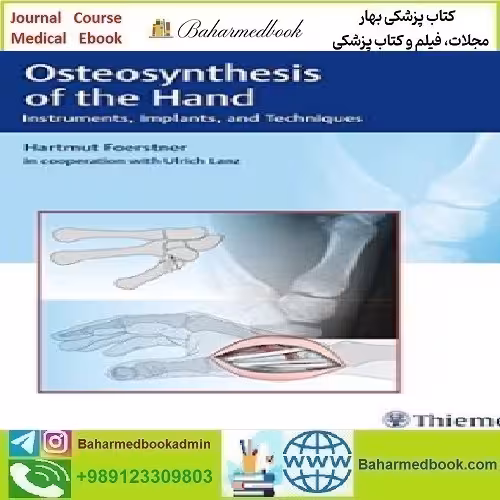 Osteosynthesis of the Hand Instruments Implants and Technique