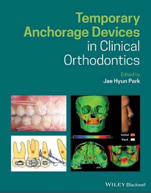 [PDF] دانلود کتاب Temporary Anchorage Devices In Clinical Orthodontics, 2020