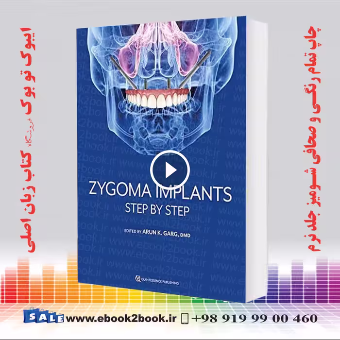 Zygoma Implants: Step by Step