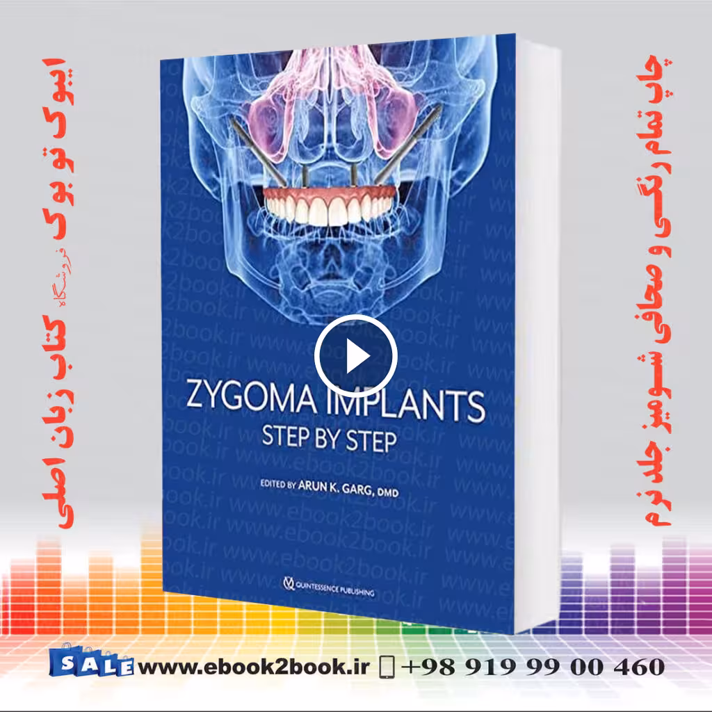 Zygoma Implants: Step by Step