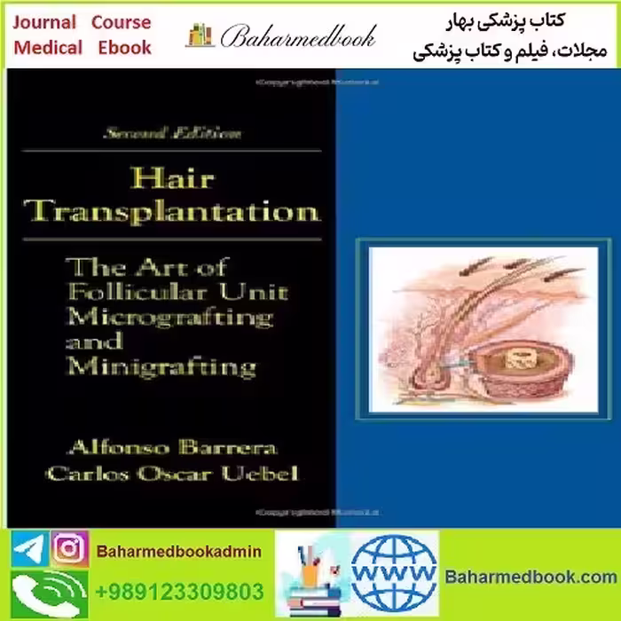 Hair Transplantation TRUE PDF price 1€ - کتاب پزشکی بهار