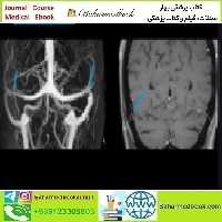Navigating the Highs and Lows of CSF Volume 2024 video c