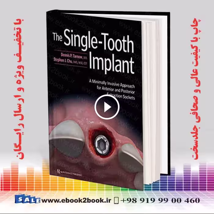 The Single-Tooth Implant