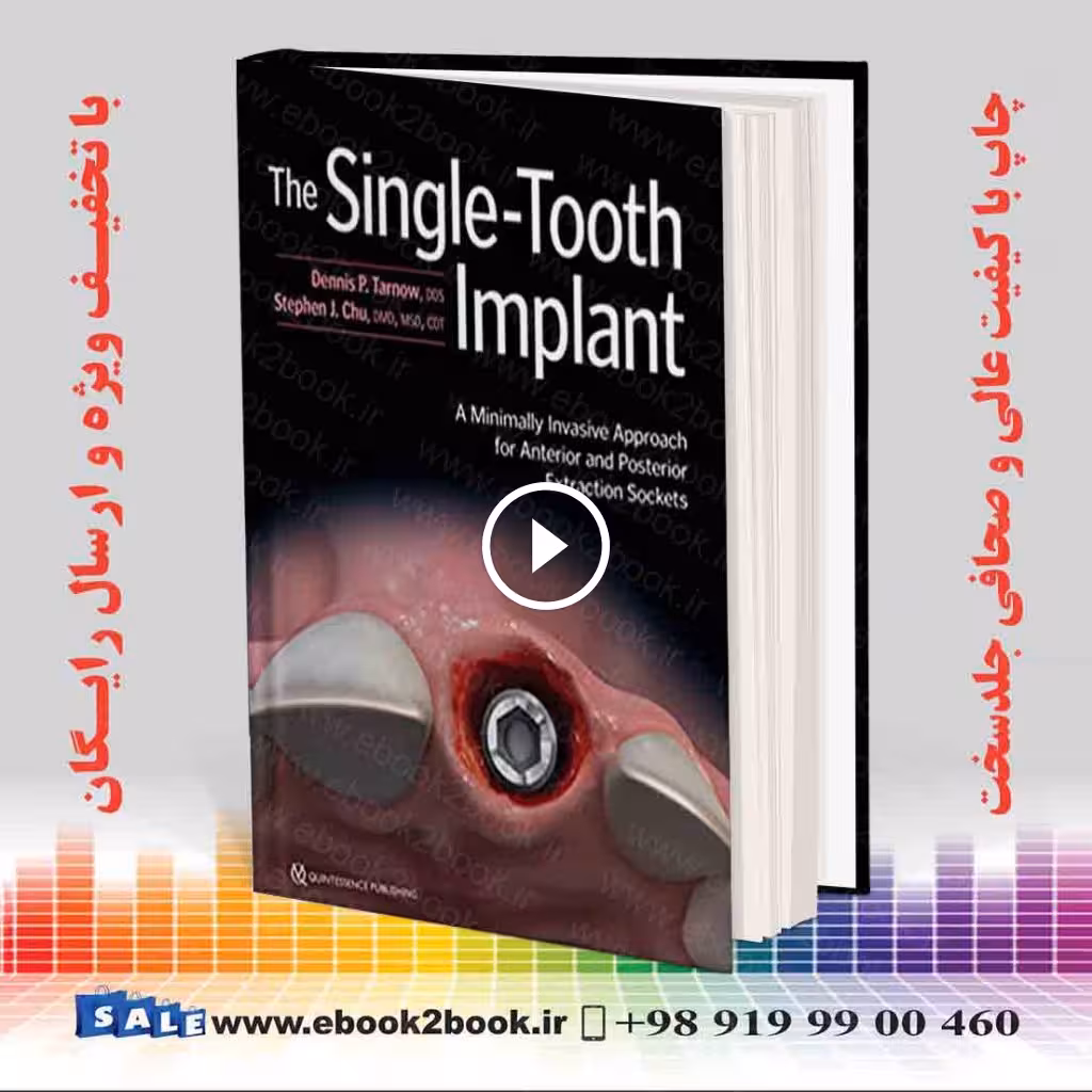 The Single-Tooth Implant