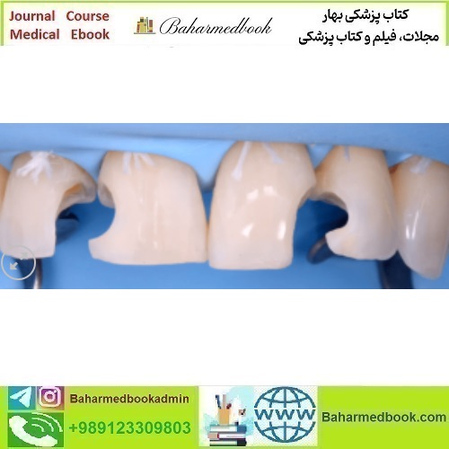 Direct and Indirect Adhesive Restorations video course price 36€ - کتاب پزشکی بهار