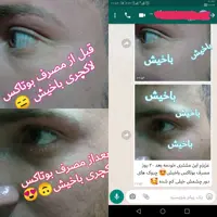کرم بوتاکس و ضد چروک60میل لاکچری از بین برنده خطوط اخم و دور دهان