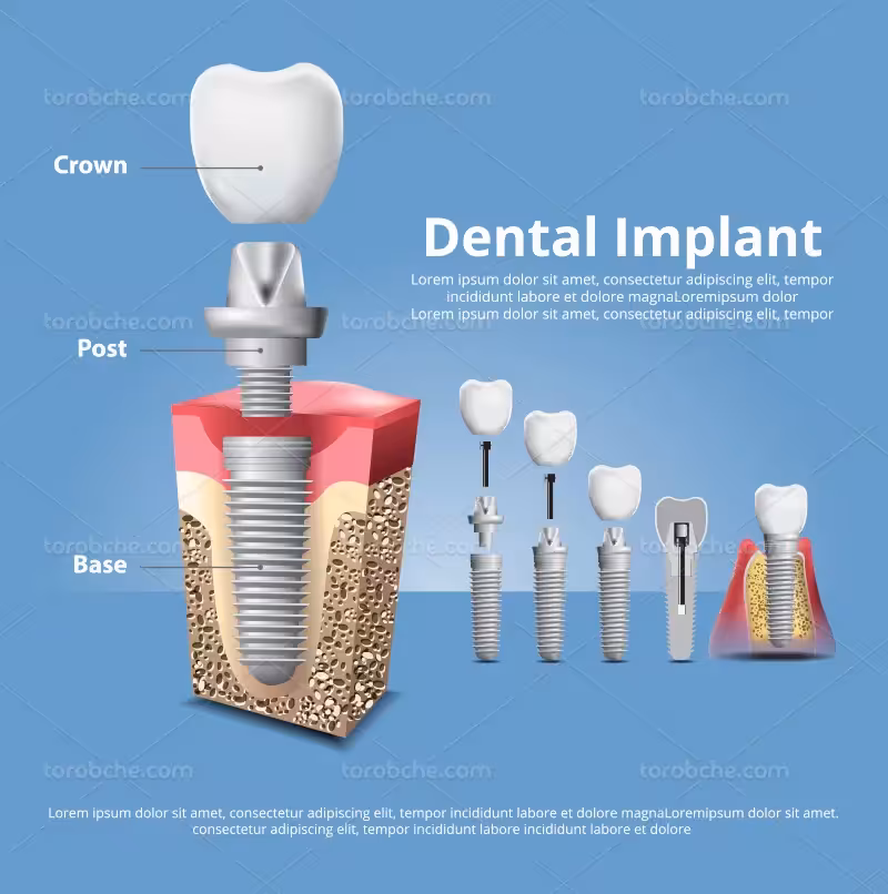وکتور مراحل ایمپلنت دندان | گرافیک با طعم تربچه