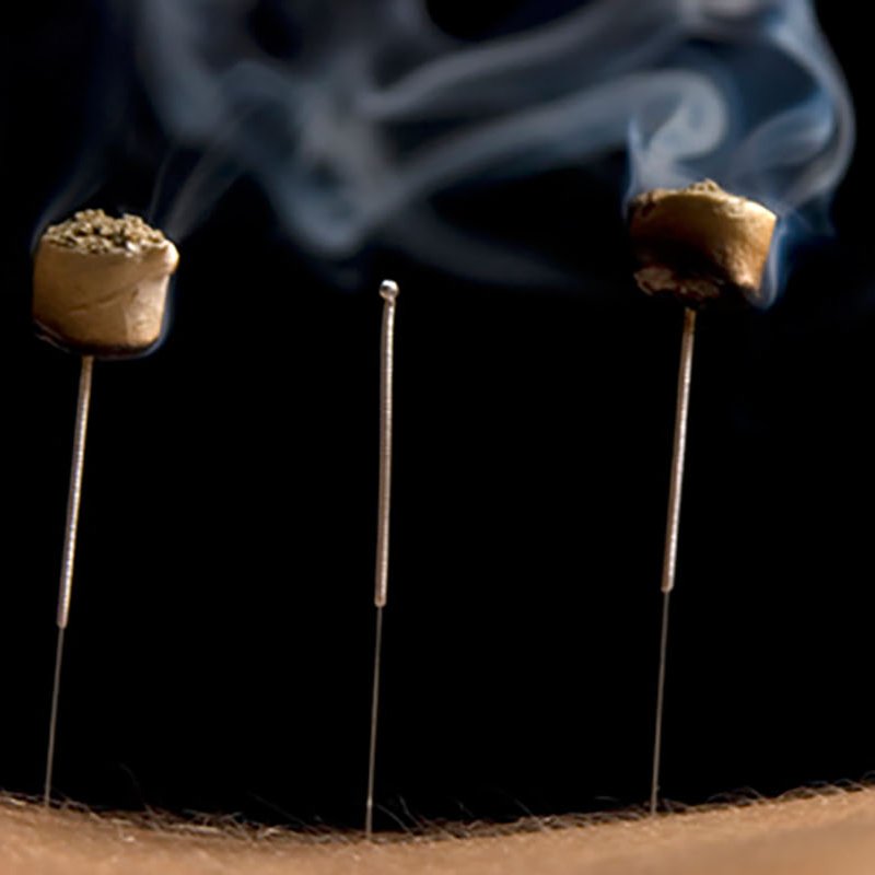 موکسا سوزنیمناسب برای تسکین دردکمر و زانو