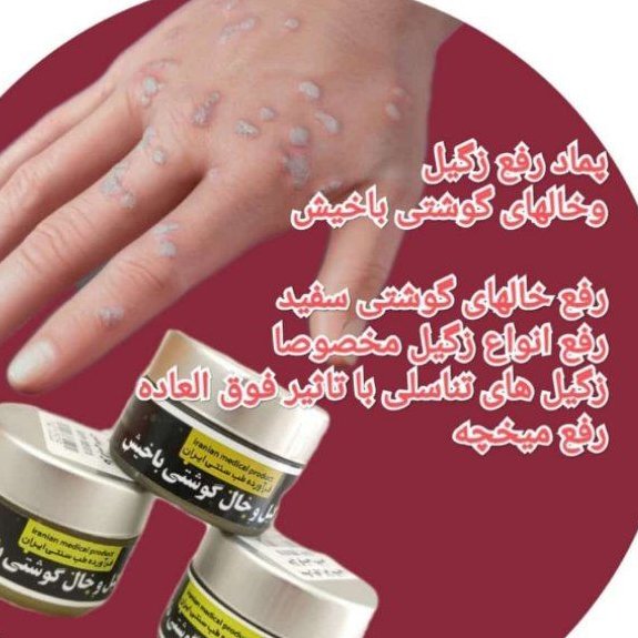 پماد رفع زگیل وخال گوشتی باخیش