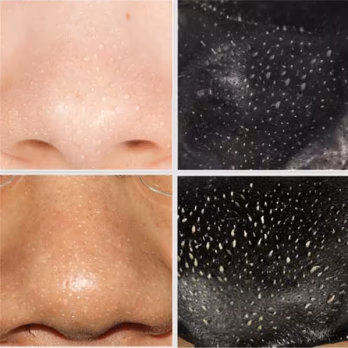 چسب پاک کننده جوش سرسیاه 