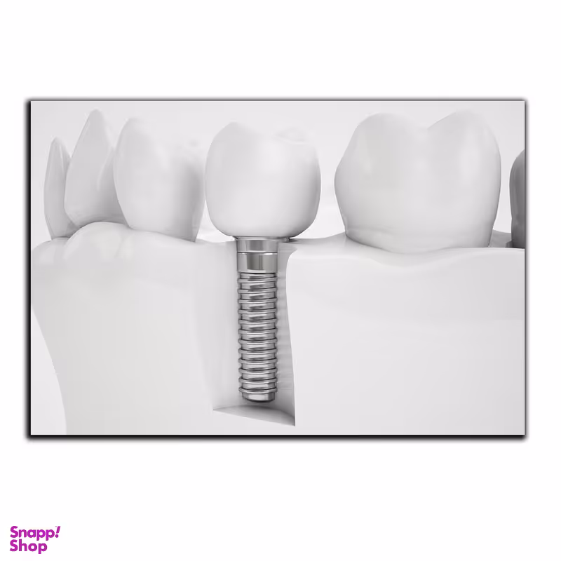 تابلو شاسی بکلیت طرح ایمپلنت دندان مدل SH-2099