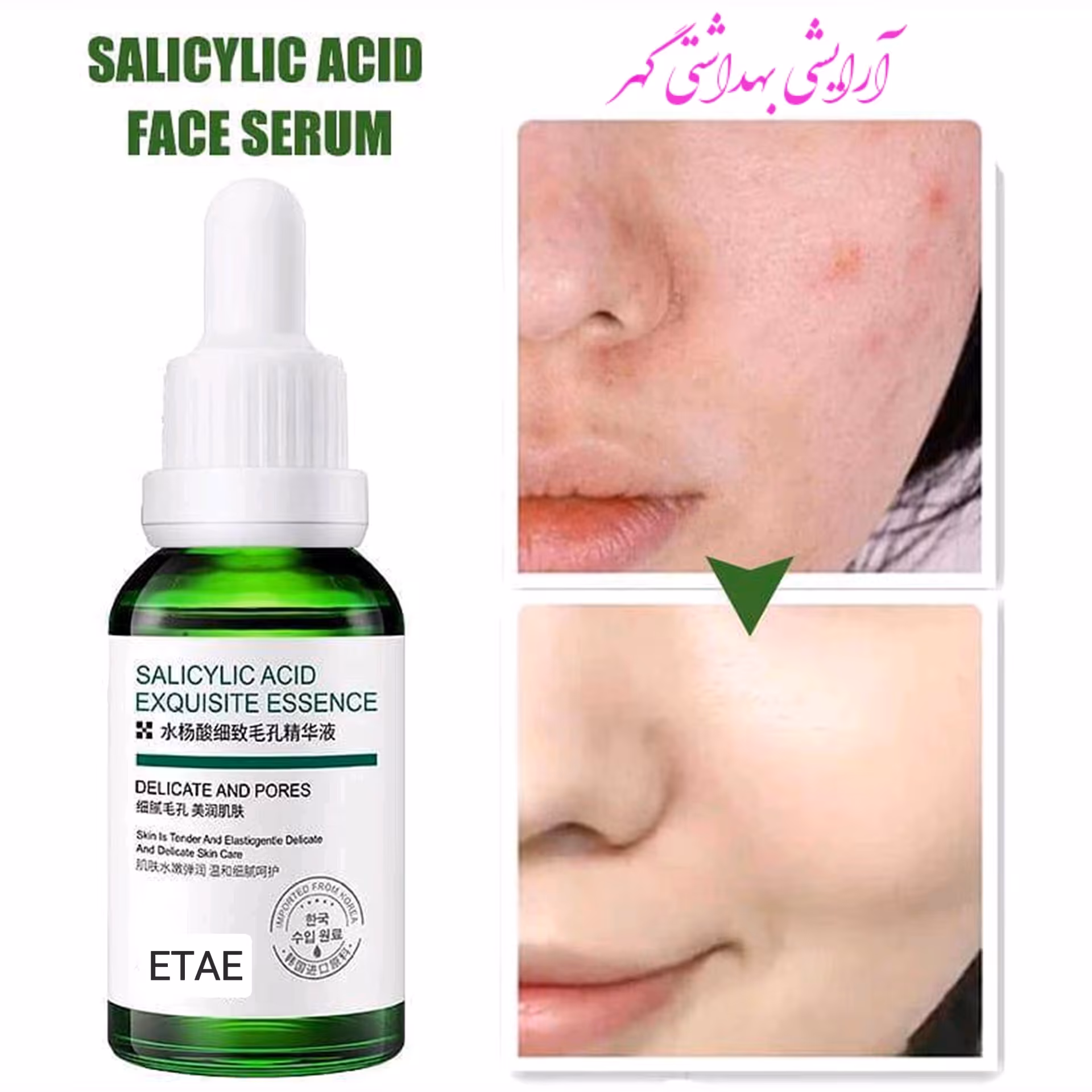 سرم تصفیه منافذ و ضد جوش سالیسیلیک اسید ایتای (ETAE) ساخت شرکت ونزن (VENZEN)