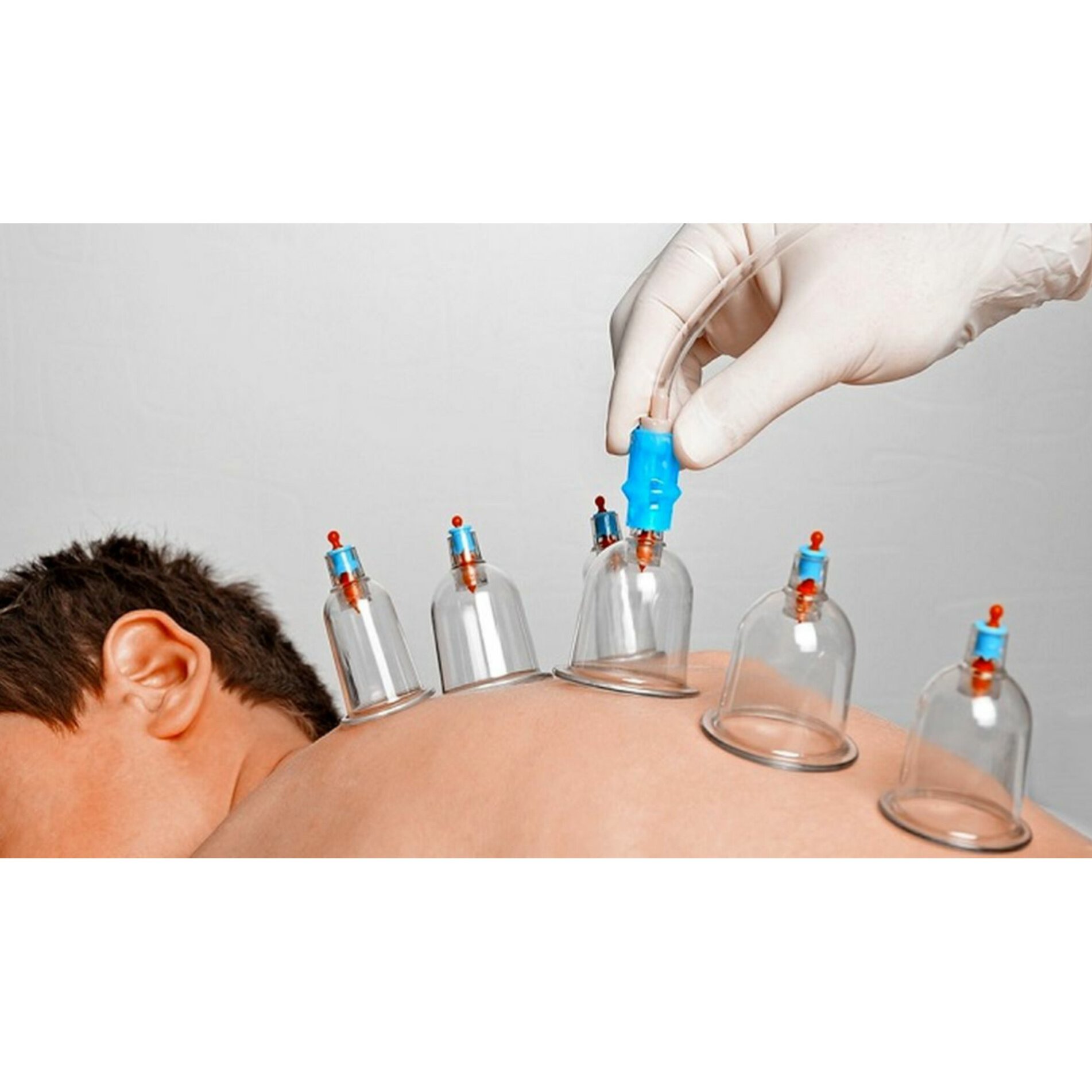 پک ویژه حجامت با بادکش ایرانی 6 لیوانه