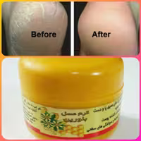 کرم (عسل )بلورین (ترک پا )