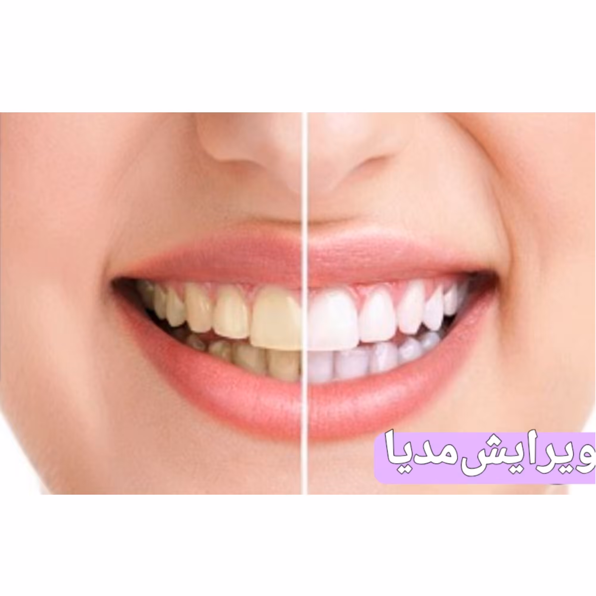 فتوشاپ دندان