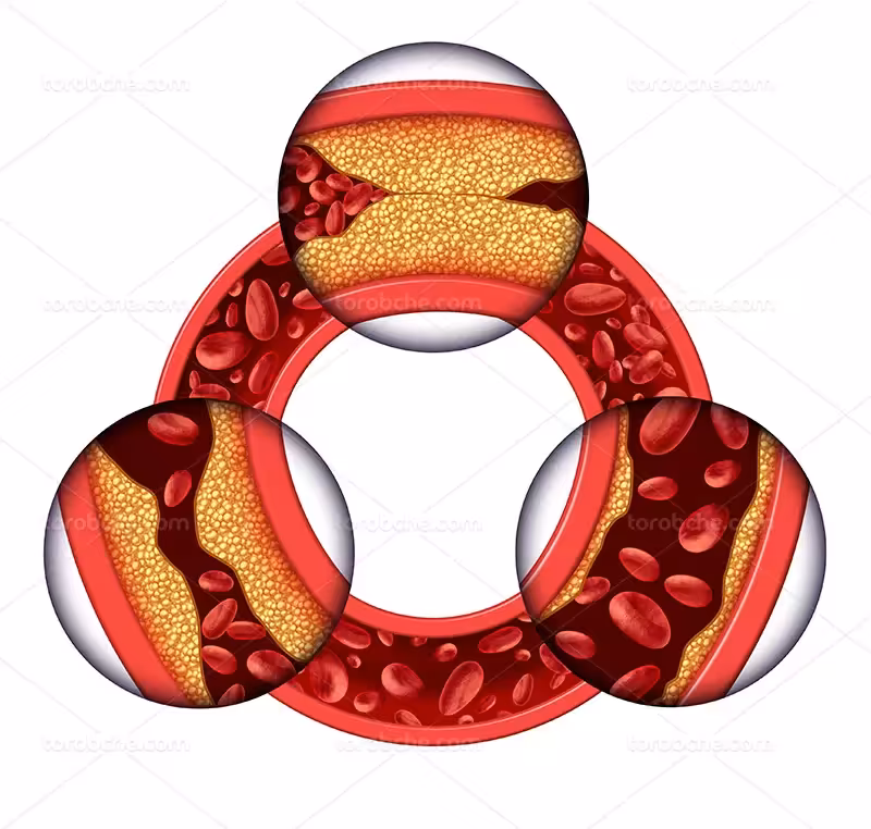 عکس با کیفیت مفهومی کلسترول خون | گرافیک با طعم تربچه