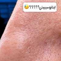 چسب بینی لامبنا از بین برنده جوشهای سرسیاه 