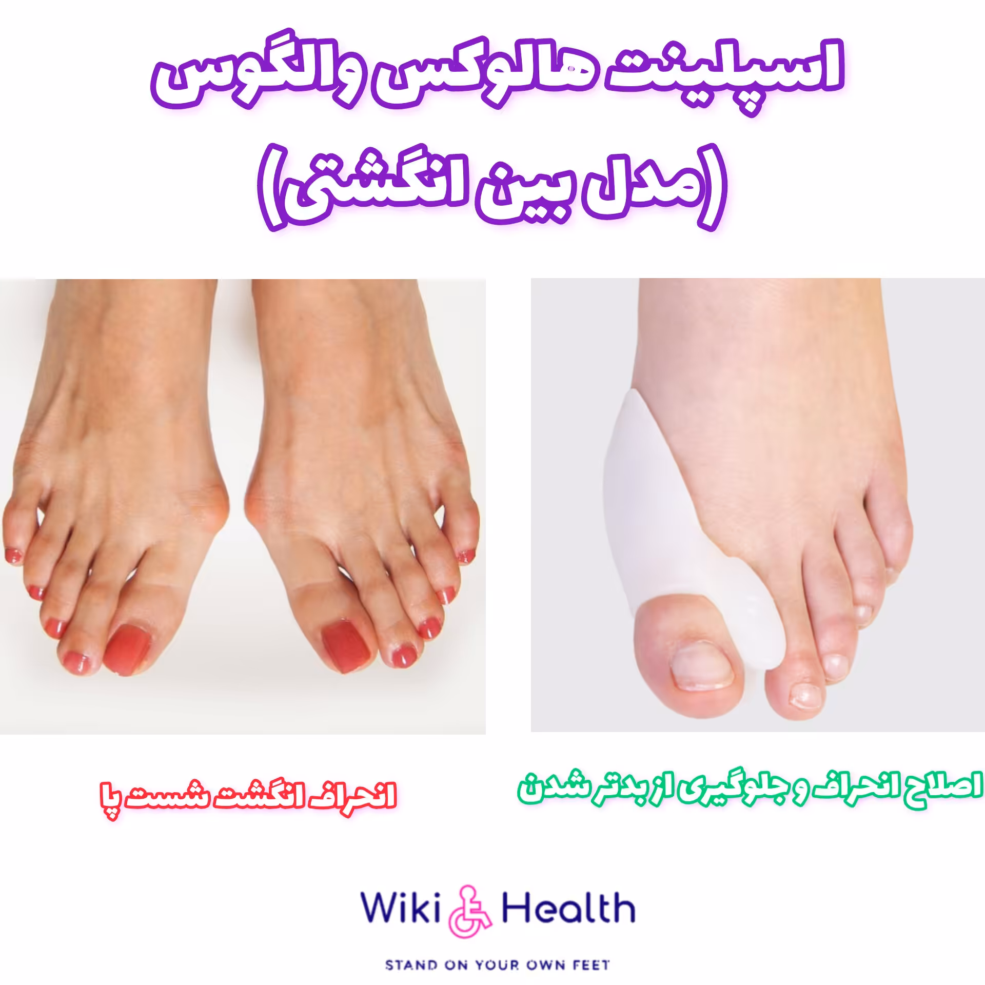 اسپلینت هالوکس والگوس(مدل بین انگشتی) (طب و صنعت) (ویکی هلث)