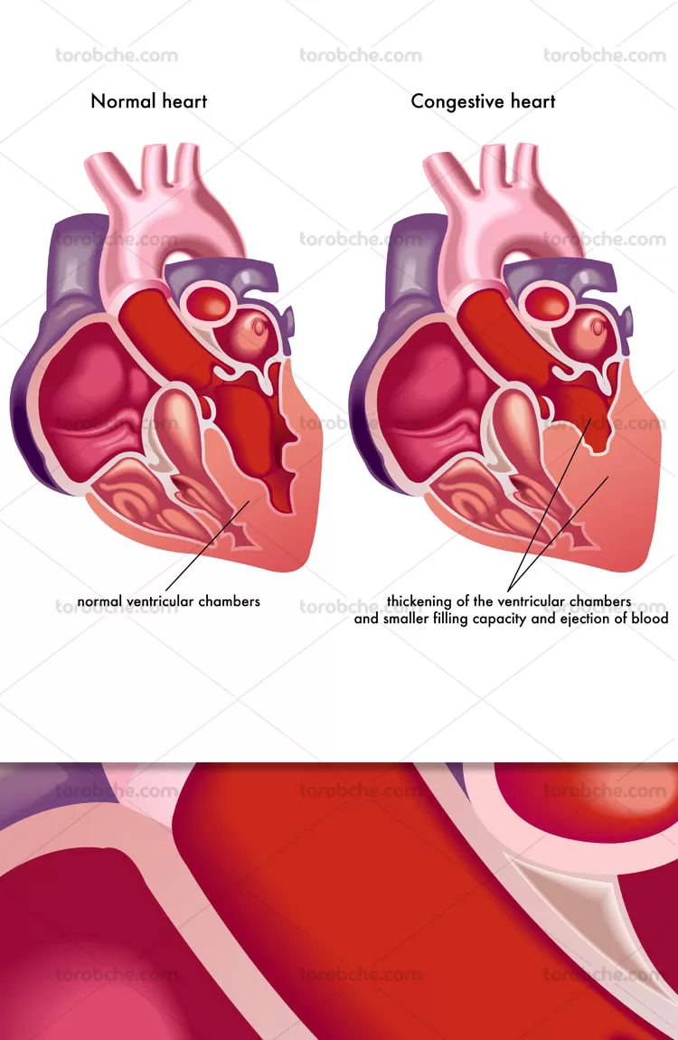 وکتور قلب سالم و گرفتگی عروق | گرافیک با طعم تربچه
