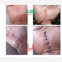پماد یاس(ترمیم کننده قوی اسکار و زخم بستر و جای جوش) 