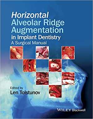 [PDF] دانلود کتاب Horizontal Alveolar Ridge Augmentation In Implant Dentistry - A Surgical Manual, 2016
