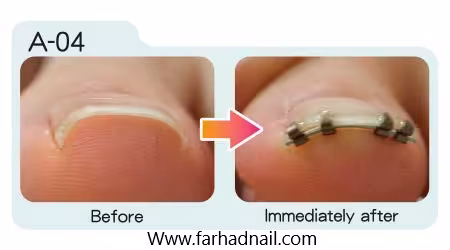 ناخن کش لیفت قلابی