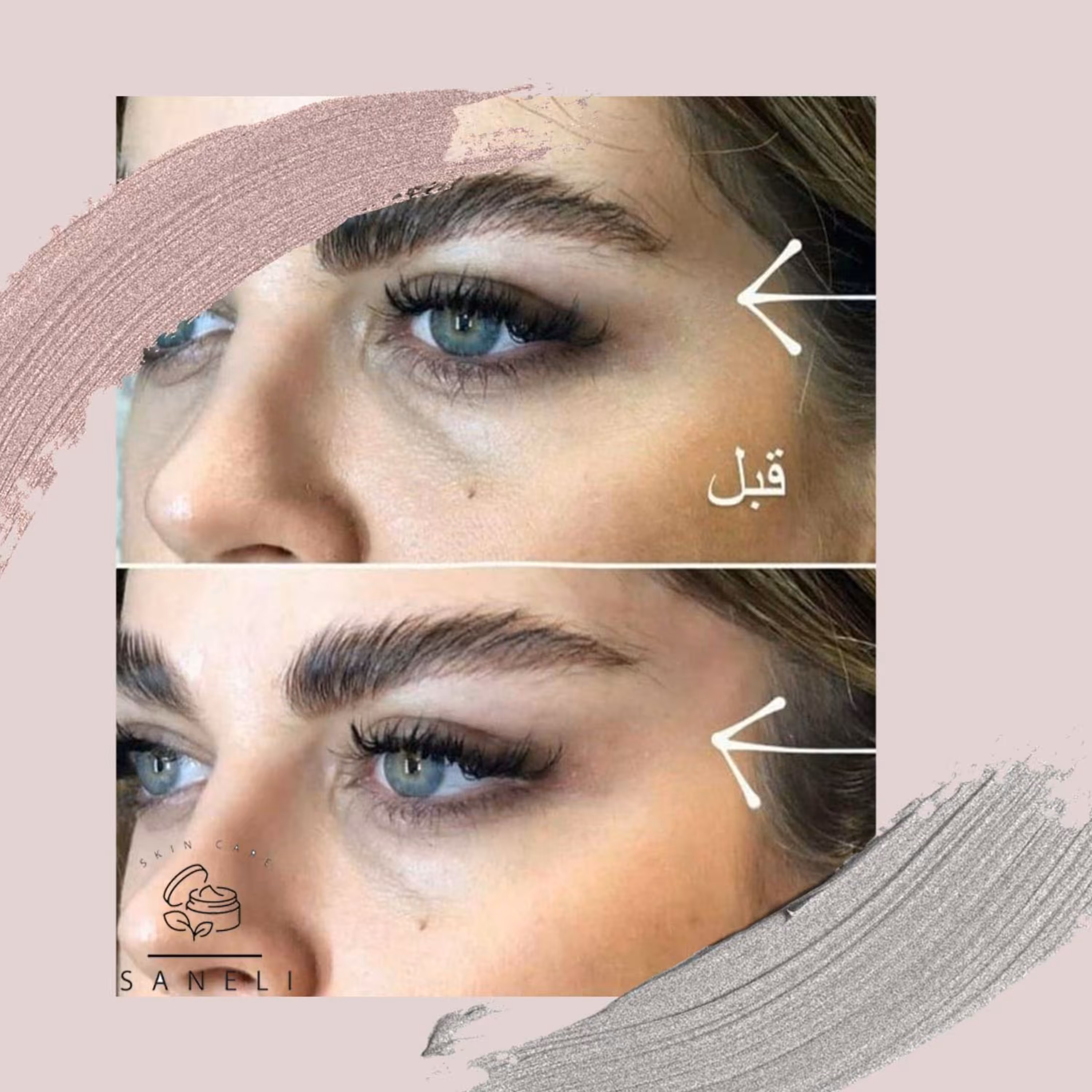 کش لیفت ابرو و شقیقه