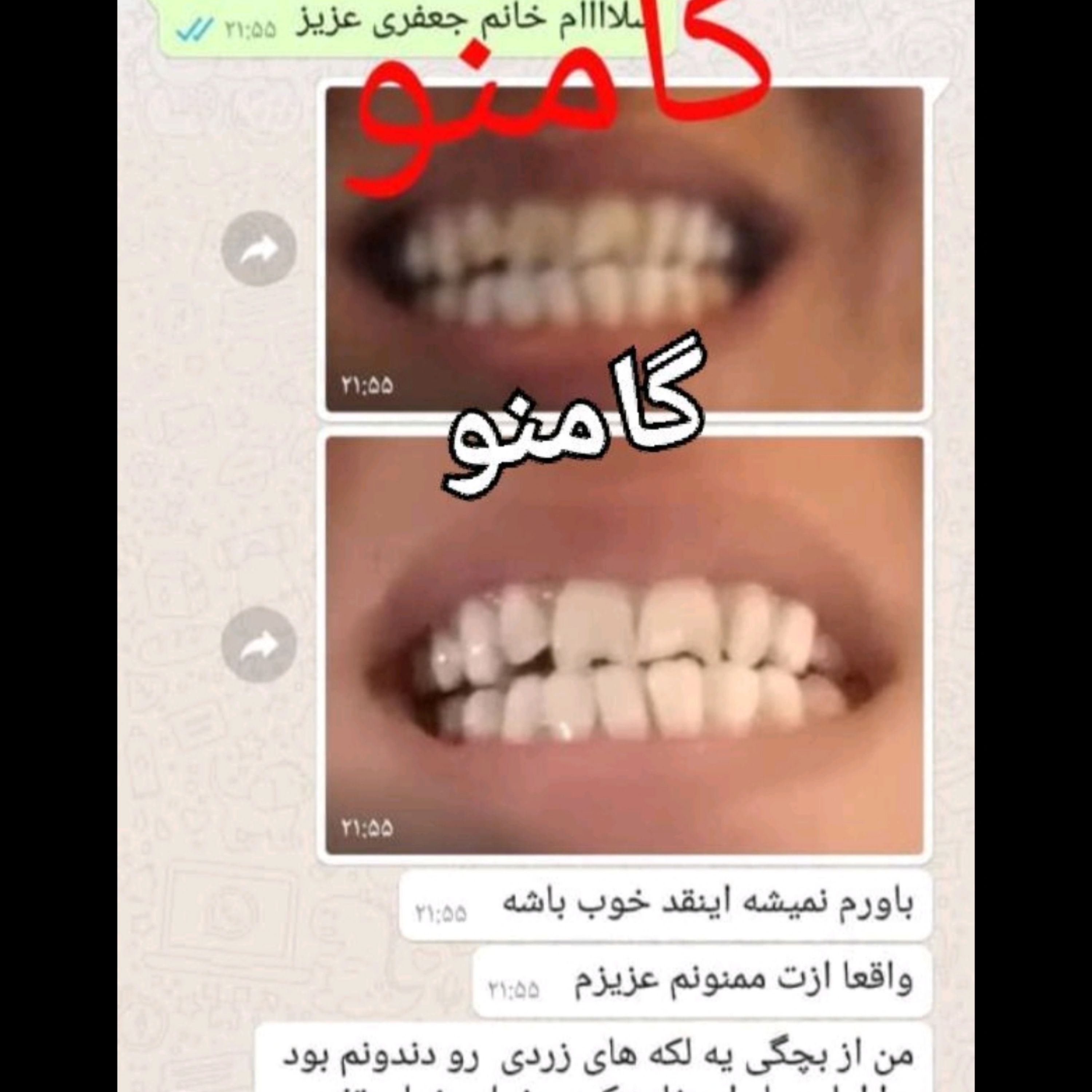 پودر سفید کننده دندان