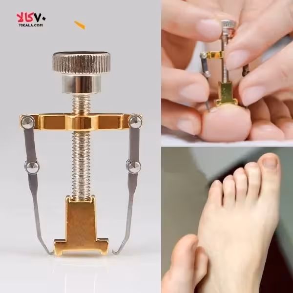 ارتودنسی ناخن اصلاح ناخن جنس درجه یک
