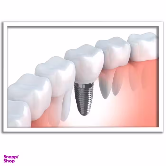 تابلو بکلیت طرح ایمپلنت دندان مدل W-s675