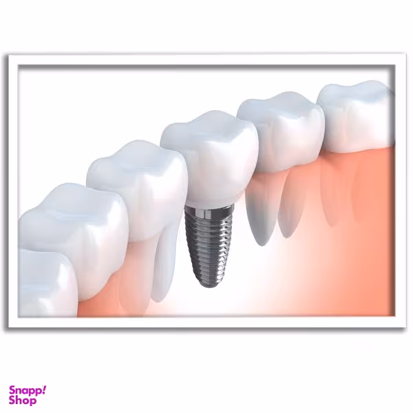 تابلو بکلیت طرح ایمپلنت دندان مدل W-s675