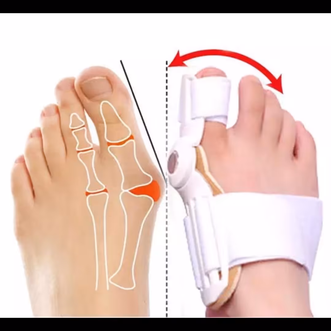 اسپلینت هالوکس والگوس (انحراف شست پا)