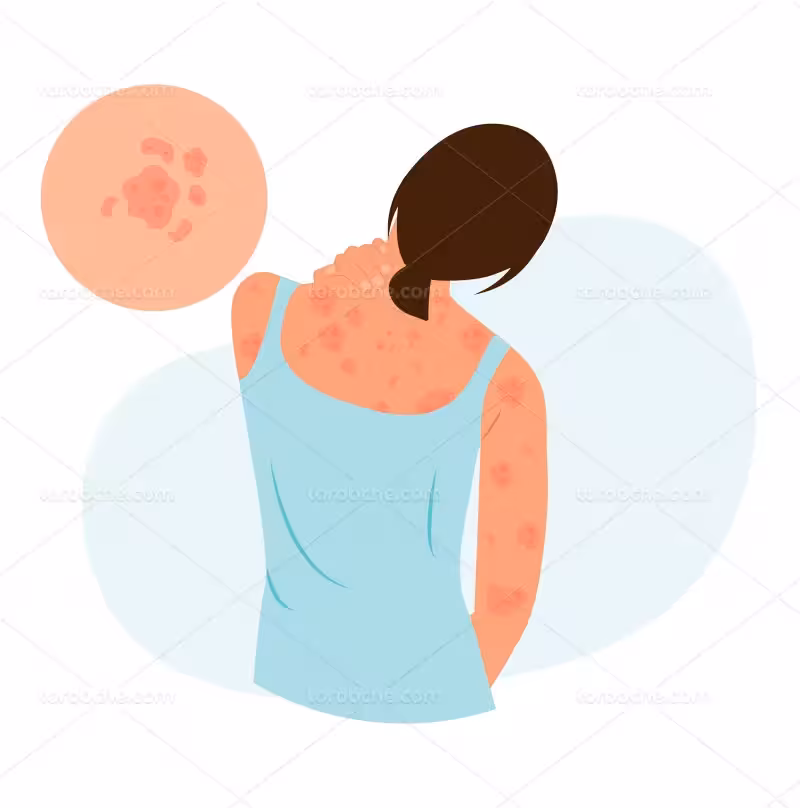 وکتور بیماری پوستی | گرافیک با طعم تربچه