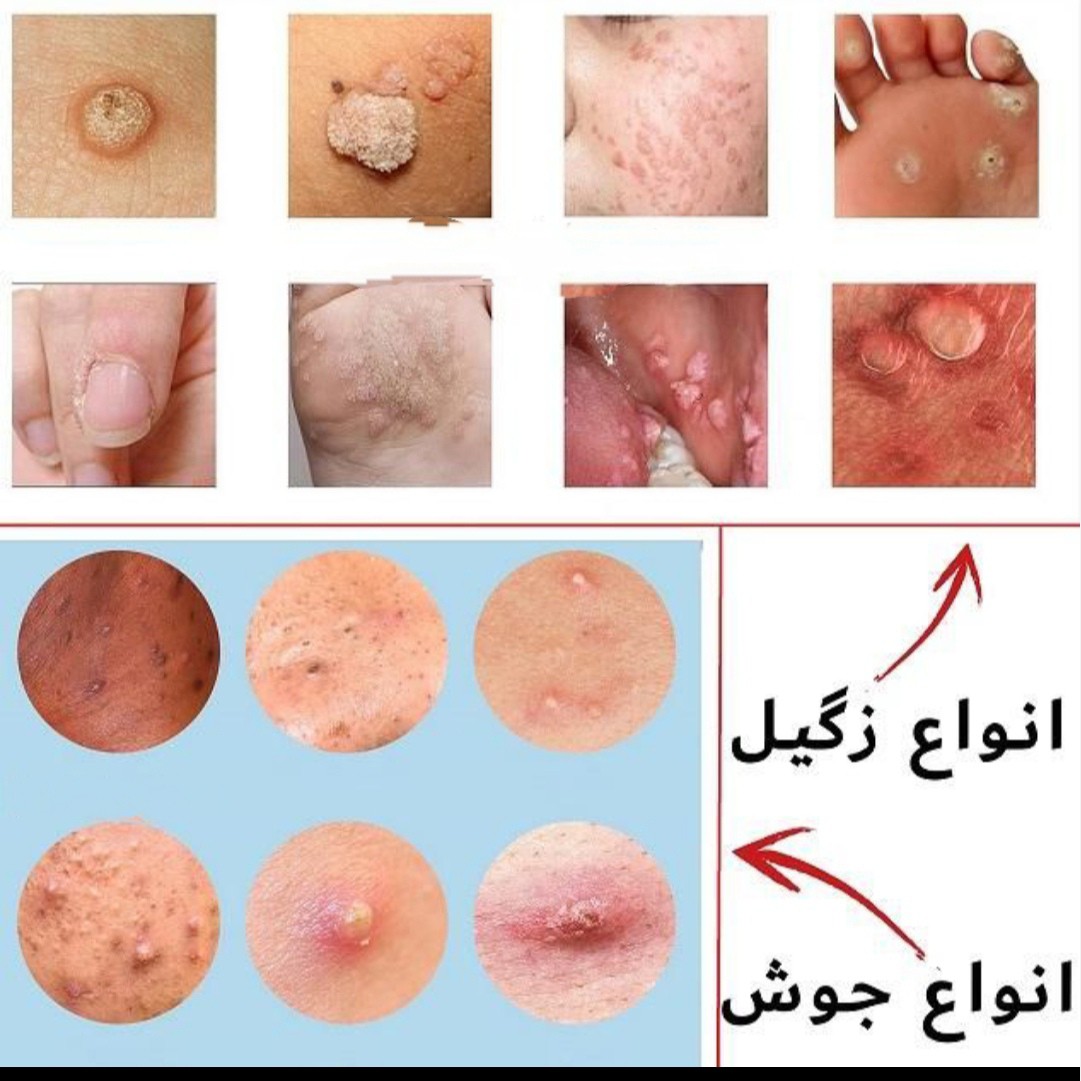 محلول رفع انواع جوش و زگیل