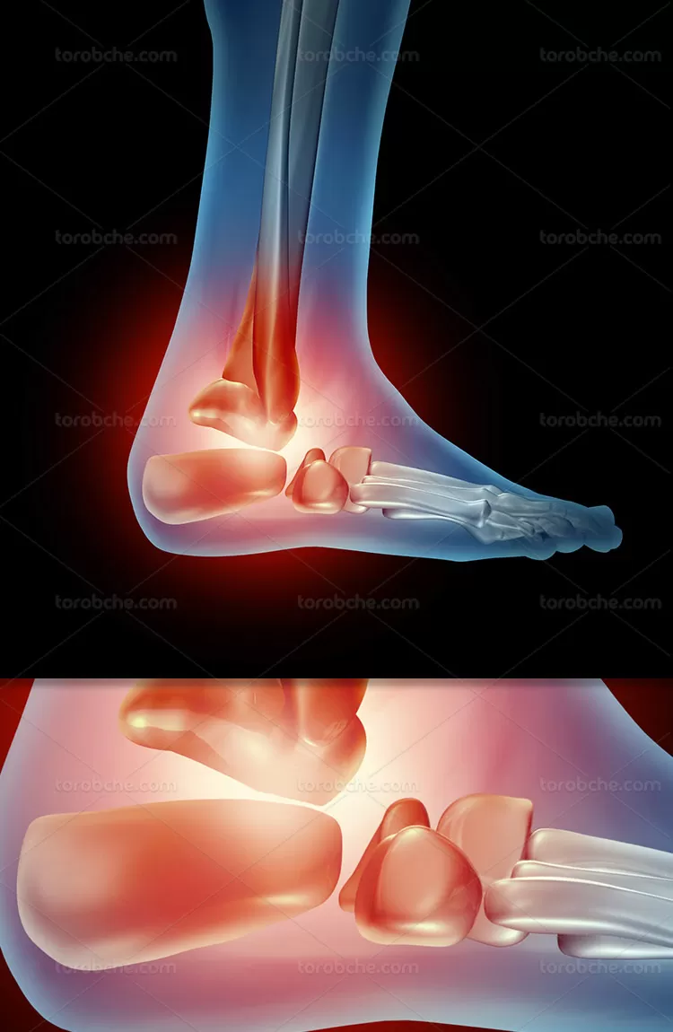 عکس سی تی اسکن مچ پا | گرافیک با طعم تربچه