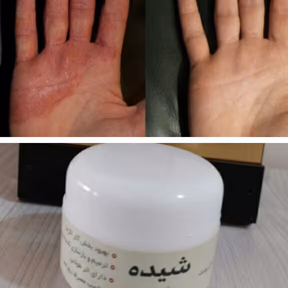 کرم اگزامای شیده