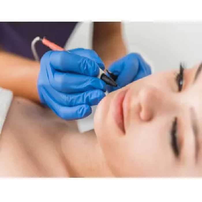 لیزر موهای سفید زائد (الکترولیز) با تخفیف ویژه در خانه پوست ابرا