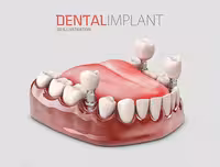 عکس باکیفیت ایمپلنت دندان | گرافیک با طعم تربچه