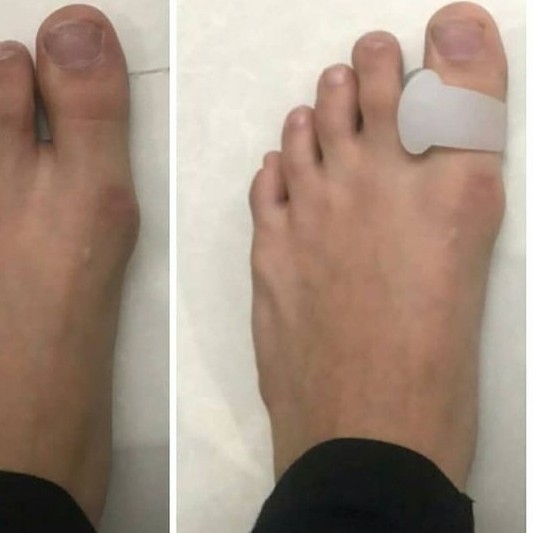 ضد پینه و فاصله دهنده تک انگشتی