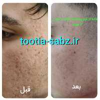 کرم گودی و حفره جای جوش و بخیه و
